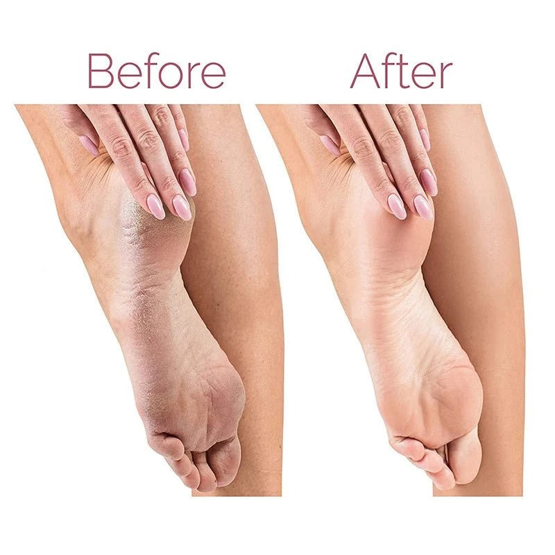 Rechargeable Electric Foot Callus Remover – 2-Speed Pedicure Foot File